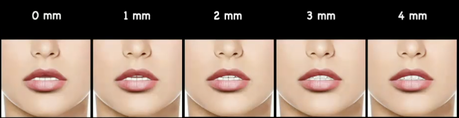 <p>pt preference of anterior dental esthetics, what was found in this study w tooth display at rest </p>