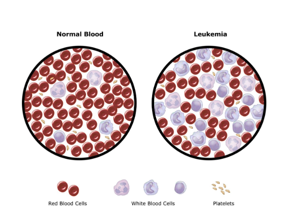 <p>What is the state of WBCs in leukemia?<br></p>
