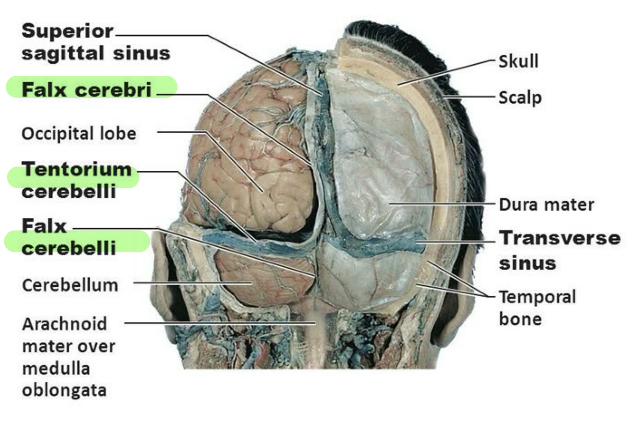 <p>-Cranial Meninges (same as spinal) And Bones</p><ul><li><p>dura has 2 layers: periosteal (external) meningeal (internal) and 3 extensions:</p><ul><li><p>Falx Cerebri: splits cerebrum hemispheres</p></li><li><p>Falx Cerebelli: splits cerebellum hemispheres</p></li><li><p>Tentarium Cerebelli: splits cerebrum and cerebellum</p></li></ul></li><li><p>venous sinus drains blood and CSF</p></li></ul><p></p><p></p>