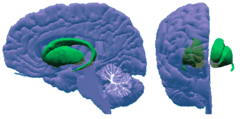 <p>islands of gray matter buried within the white matter</p><p>- caudet nucleus, putamen, globus pallidus, amygdala</p>
