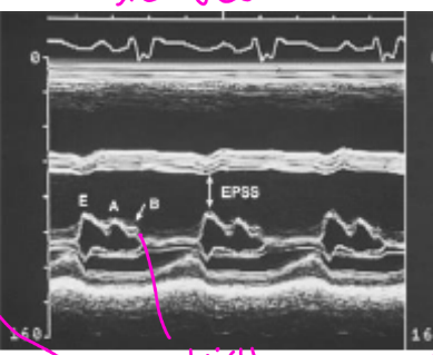 <p>High LVEDP and LAP</p><p>(MV leafleats remain semi open in diastole it occurs b/c the LAP exceeds the LV pressure which prolongs the a wave for a little and thats why you see the b - bump)</p>