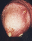 <p><strong>STIs: </strong>Statistics for <u>Neisseria Gonorrhoeae or Gonorrhea </u></p>