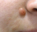 <p>dermal pigmented nevi*</p>