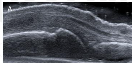 <p>What grade is the synovial hypertrophy?</p>