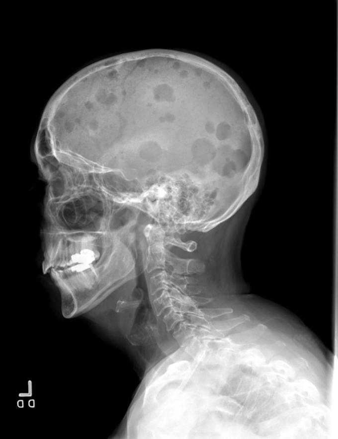 <p>Trabeculae reabsorbed turns the bone darker in color; moth eaten or permeative pattern of destruction; “eat” away pedicle of bone; has a “swiss cheese” appearance in the skull </p>