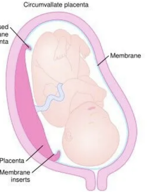 <p>Circumvallate placental tissue is:</p><ul><li><p>flat and noted on approximately 20% of placentas</p></li><li><p>associated with a thickened rolled chorioamniotic membrane</p></li><li><p>extremely rare, 1:20,000 to 40,000 pregnancies</p></li><li><p>prone to fetal macrosomia</p></li></ul><p></p>