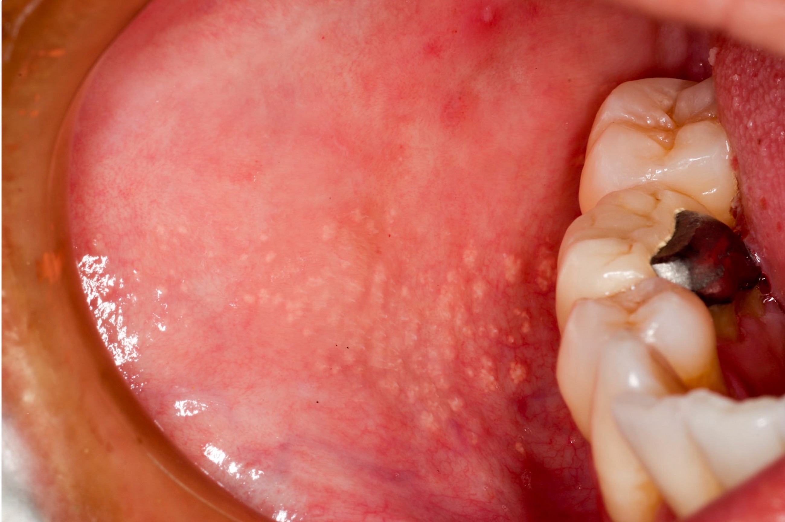<p>What is this lesion on the buccal mucos?</p>