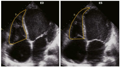 <p>Trace the endocardial tissue border from the tricuspid annulus to apex back to the tricuspid annulus. Make measurement at both end diastole and end systole.</p>