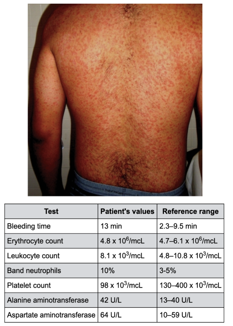 <p>A 34-year-old male presents to the emergency department with fever, intense headache, shaking chills, nausea, vomiting, and diarrhea. He also has a petechial rash that began on his wrists and ankles but has spread to the rest of his body, including his palms and soles. The patient indicates that he was hunting about 1 week before symptoms started. He does not recall being bitten by any insects. A photograph of his rash is obtained, as shown in the exhibit. Lab values are listed below.</p><p>Urinalysis reveals both elevated protein and red blood cells. The most likely etiology of the patient's condition is:</p>