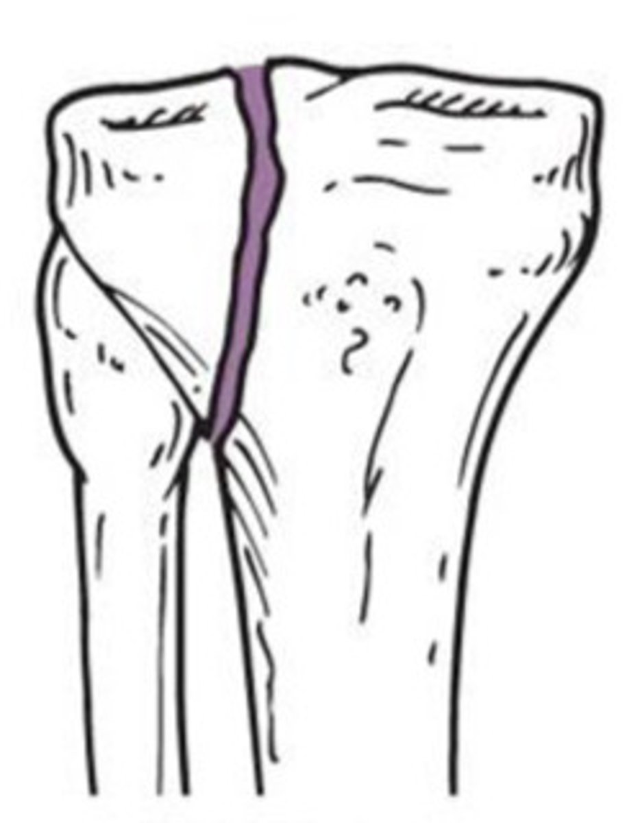 <p>What type of fracture does this show?</p>