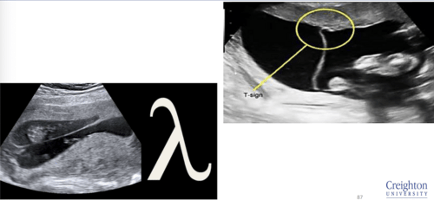 <p>Dichorionic twins: Lambda sign</p><p>Monochorionic twins: T sign</p>