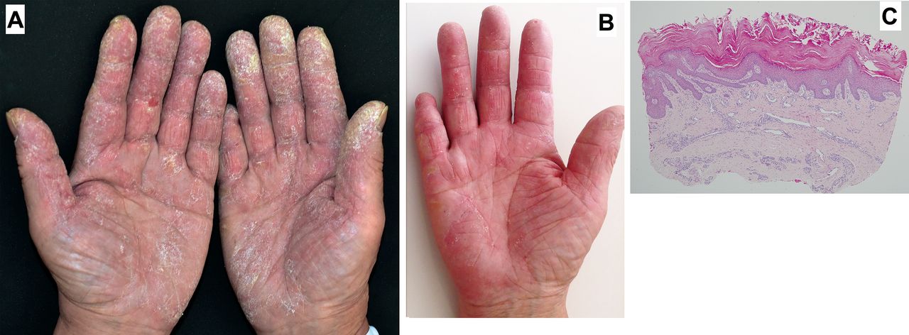 <p>What skin presentation caused by dermatomyositis is shown here?</p>
