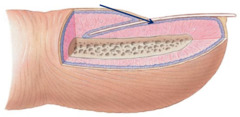 <p>The deeper layer of epidermal epithelium beneath the nail body.</p>