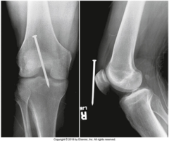 <p>1. superimposition of anatomic structures</p><p>2. localization of lesions or foreign bodies</p><p>3. determination of alignment of fractures</p>