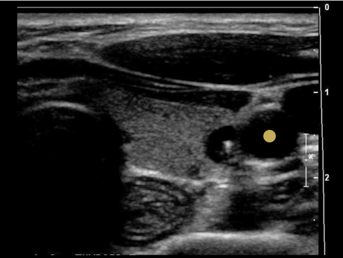 <p>The common carotid artery is lateral to the thyroid gland. The internal jugular vein is slightly anterior and lateral to the common carotid artery.</p>