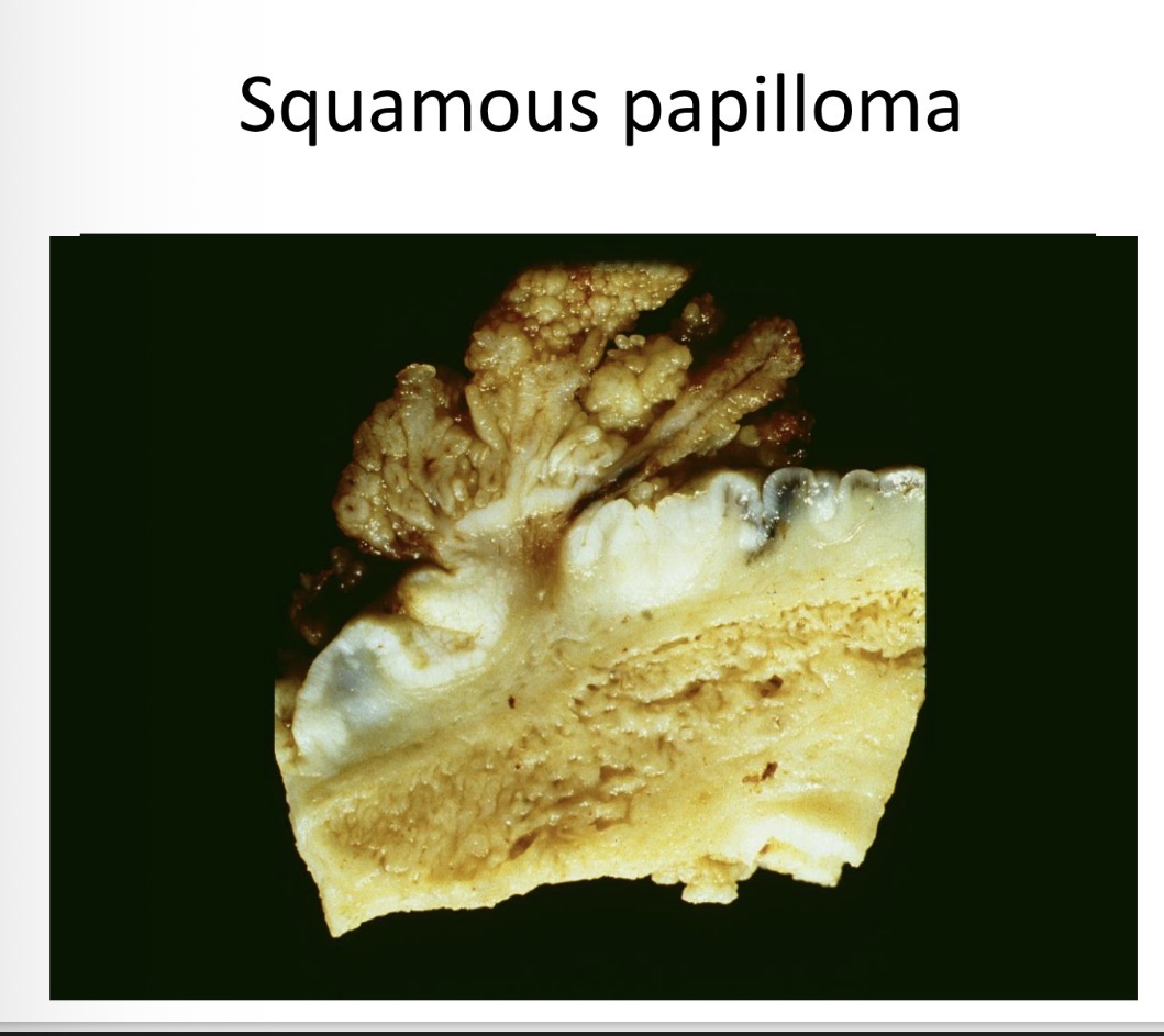 <p>Sq cell papilloma - gross </p>