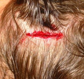 <p>What bandaging technique should be used for this injury?</p>