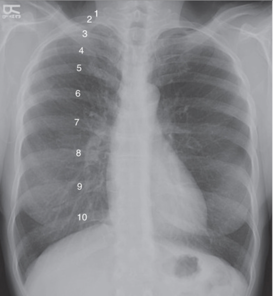 <ul><li><p>fills lungs adn contracts diaphragm</p></li><li><p>10 posterior ribs are visible above diaphragm</p><ul><li><p>8-9 in hospitalized pts </p></li></ul></li></ul><p></p>