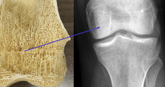 <p>branching bony plate within the cancellous bone</p>