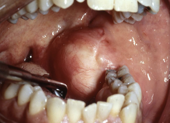 <p>most common in long bones (3% in head and neck); painless mass or swelling of the jaw </p>