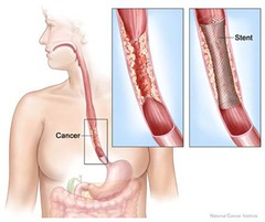 <p>smoking increases the risk of esophageal cancer</p>