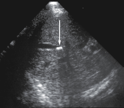 <p>echogenic foci in the right upper quadrant of the fetus that may or may not produce posterior shadowing </p>