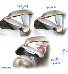<p>in a "piano key sign" injury, what ligaments of the shoulder are torn?</p>
