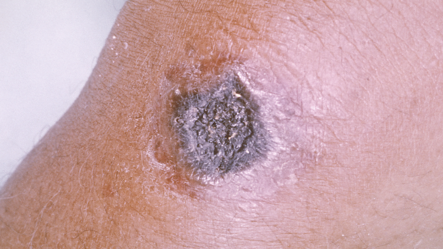 <p>Cutaneous anthrax</p>