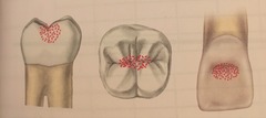 <p>on the surface of tooth (caries on pits/fissures)</p>