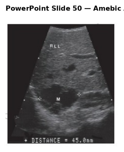 <p>newly formed abscess appears echogenic and becomes hypoechoic as it matures.</p><p>color doppler usually shows no flow</p><p>image shows 4.5cm complex cystic mass in right lobe</p>