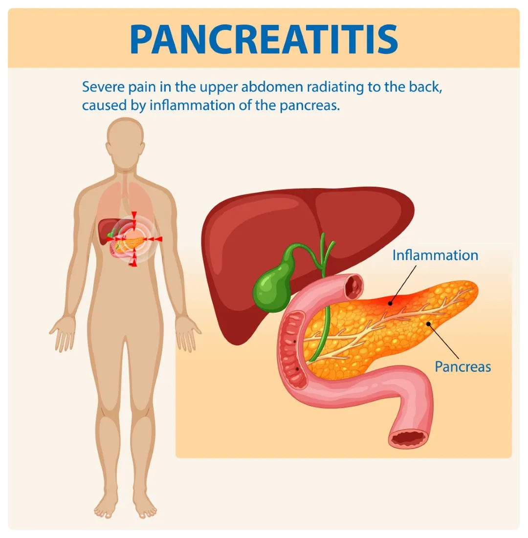 <p>An <strong>inflammation of the pancreas</strong> that causes <strong>abdominal pain and digestive problems</strong>.</p>