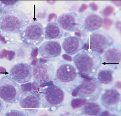 <p>What tumor cell type?</p>