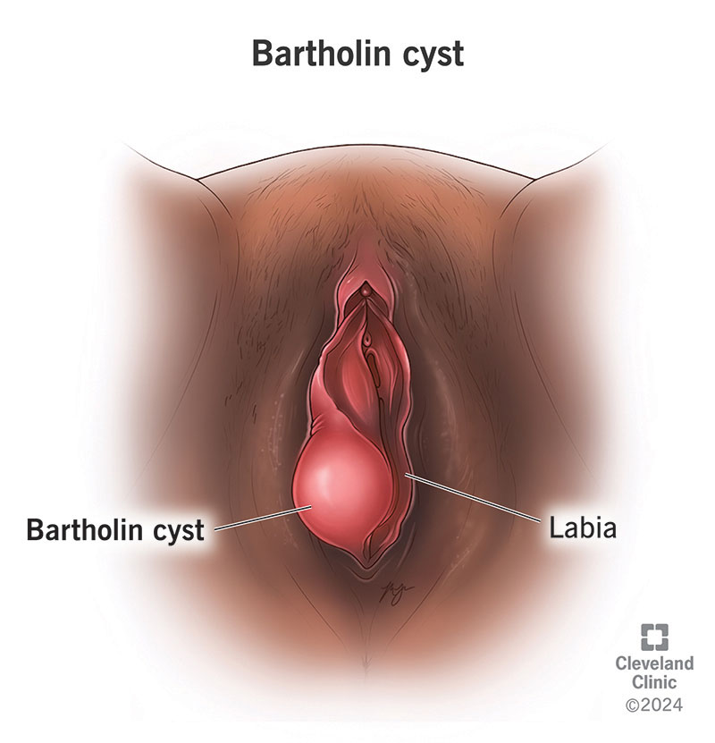 <p>Blockage of ducts in the vulva</p><p>-Presentation: painless unilateral vulvar mass that is typically asymptomatic but can cause discomfort during sexual intercourse if large </p><p>-Dx: clinical, CBC, culture of drained fluid if > 3cm and supportive if < 3 cm </p>