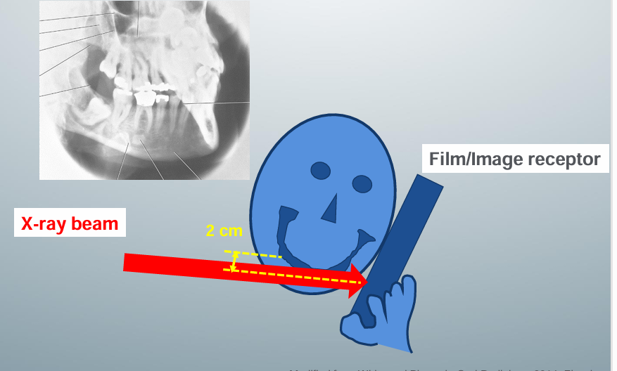 <p>-image receptor placed against the pt’s cheek on the side of interest and centered in the premolar-molar region</p><p>-pt slightly tilts head to the side of interest and protrudes mandible</p><p>-central x-ray beam positions are directed at 2cm below the contralateral mandibular angle</p>