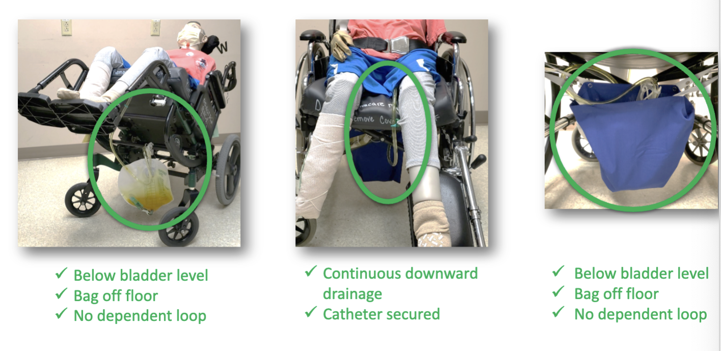 <p>preventing catheter-associated UTIs requires team approach</p><ul><li><p>ensuring continuous downward drainage</p></li><li><p>paying attention to foley placement during transfers</p></li><li><p>placing below bladder level at all times</p></li></ul><p></p>