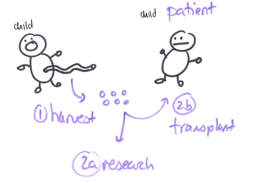 <p>source: umbilical cord containing some blood stem cells</p><p></p><p>used for: research &amp; allografts (to others)</p><p></p><p>false claims:</p><ol><li><p>CANT be used as an autograft (for self), bc if the child does have to blood disease, their cell would be defective </p></li><li><p>CANT treat all diseases, bc blood stem cells are multipoint - THUS, can only be used to treat blood disorders </p></li></ol><p></p>