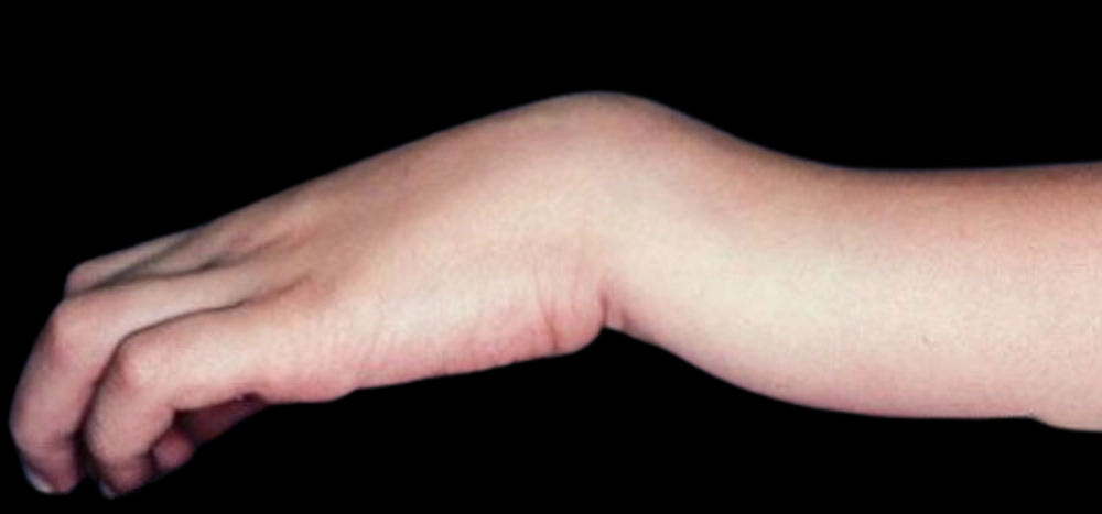 <p>Transverse + partial fragmentation of distal radius that angles dorsally</p><p>FOOSH</p><p>Dinner fork deformity due to dorsal angulation of radius fragment</p><p>Associated transverse fracture of ulnar styloid</p>