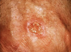 <p>Workup for suspected SCC:</p><p>-shave, punch or excisional biopsy (depending on site of lesion)</p><p>-CT/MRI for advanced stages of SCC</p>