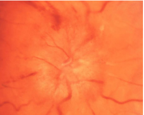 <ul><li><p>Inflammation of the optic nerve</p></li><li><p>Typically unilateral</p></li><li><p>Pain on eye movements</p></li><li><p>Associated with autoimmune conditions</p><ul><li><p><u>Multiple sclerosis</u></p></li></ul></li></ul><p></p>