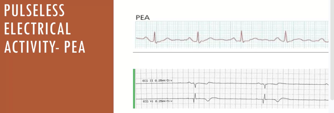 <p>(PT2)pulseless electrical activity - pea</p>