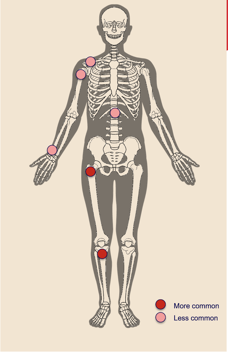 <ul><li><p>Metaphysis</p></li><li><p>Can be Diaphysis</p></li><li><p>Eccentric location</p></li></ul><p></p>