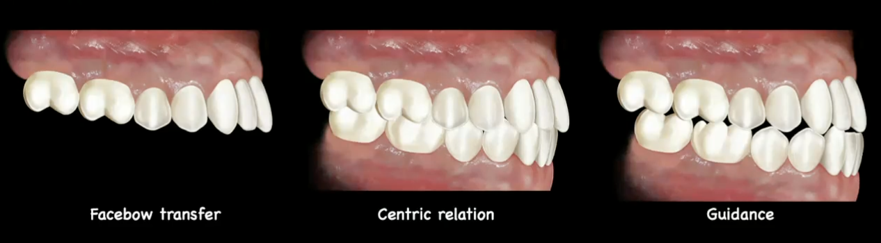 <ol><li><p>maxillary → w facebow transfer </p></li><li><p>mandibular → use bite record in mount in centric relation </p></li><li><p>establish occlusion and guidance </p></li></ol><p></p>