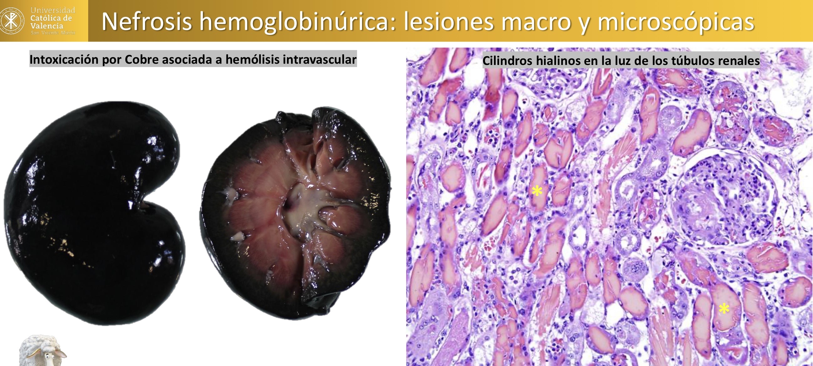<p>Nefrosis hemoglobinurica, intoxicación por cobre </p><p>Asociada a hemolisis intravascular y cilindros hialinos en la luz de los túbulos renales </p>