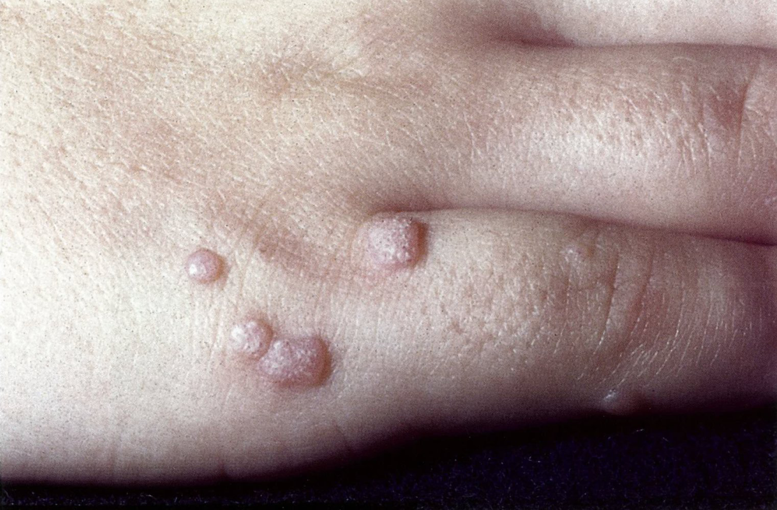 <p>A common, benign wart caused by human papillomavirus (HPV) infection, characterized by rough, raised lesions typically found on the hands and feet. </p>