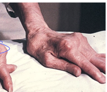 <p>joints become progessivley inflamed and painful</p><p>SQ nodules</p>