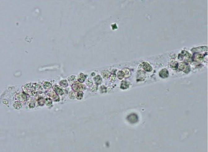 <p>Identify this cast. What combination of urine dipstick results would correlate with this finding?</p>