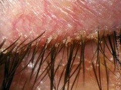 <p>infection/inflammation of eyelids that presents with eye irritation and redness/irritation of eyelids</p>