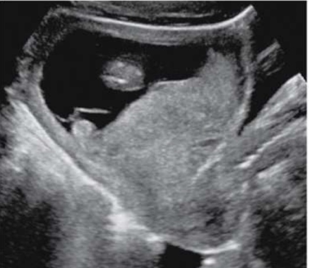 <p>Any portion of cervical internal os is obstructed by placenta. risk factors are Hx of previa, prior c-section, ama, increased parity, smoking and enlarged placenta; 4 types of previa: </p><ul><li><p><u>total or complete</u>: occurs when entire cervical os is obstructed by an overlying placenta; associated with vaginal bleeding and necessitate cesarean delivery (in image)</p></li><li><p><u>partial or incomplete</u>: occurs when portion of cervical os is obstructed by overlying placenta; associated with vaginal bleeding and necessitates cesarean delivery</p></li><li><p><u>marginal</u>: placenta extends up to but not above the internal cervical os; follow-up exams during final weeks of pregnancy to see whether position of placenta has changed</p></li><li><p><u>low lying</u>: occurs when placentas lower edge lies within 0.5-5cm from internal cervical os; in follow-up ultrasound exams, placenta frequently appears to move farther from internal cervical os</p></li></ul><p></p>
