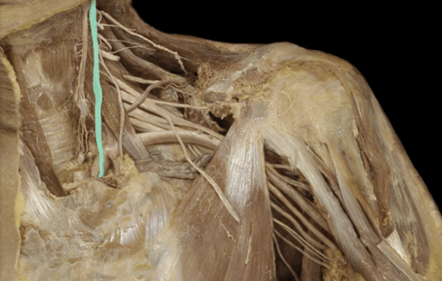 <p>Cranial Nerve X</p><p>Goes posteriorly compared to phrenic nerve (which is anterior)</p>