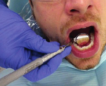 <ul><li><p>11 to 1 o’ clock positions</p></li><li><p>Rest ring and pinkie on right side of patient’s face near corner or one of the premolars</p></li><li><p>Use mirror head to push tongue back gently so lingual surfaces of teeth is seen in the mirror</p></li></ul><p></p>